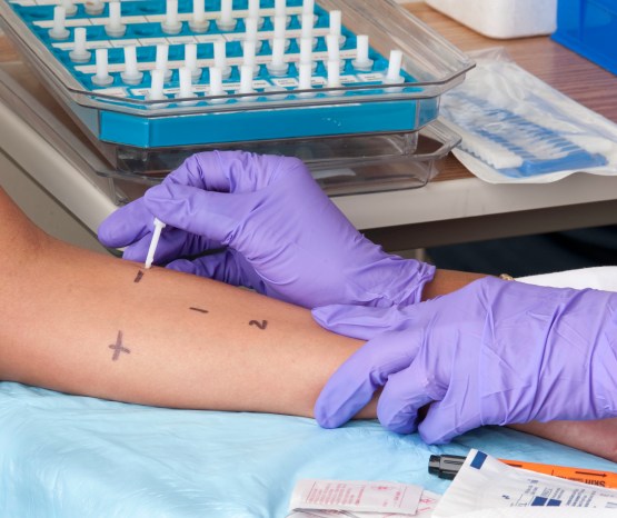 Skin_prick_testing_for_allergies.jpg